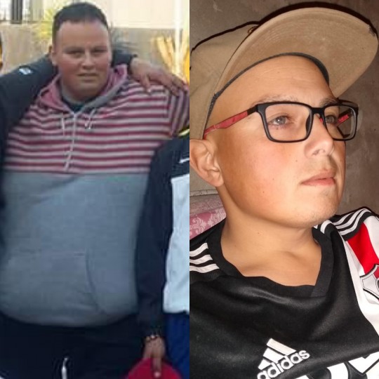 JUAN MANUEL PARTICIPANTE DE CUESTION DE PESO SE LE REALIZA UN BYPASS GASTRICO