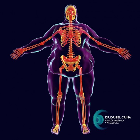 RECONSTRUCCION ABDOMINOPERINEAL POST BARIATRICA