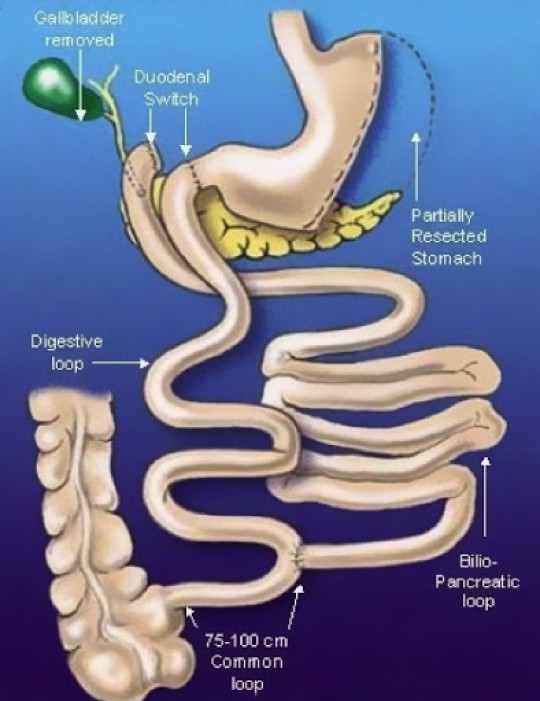 CIRUGIA PARA GRANDES OBESOS SWITCH DUODENAL